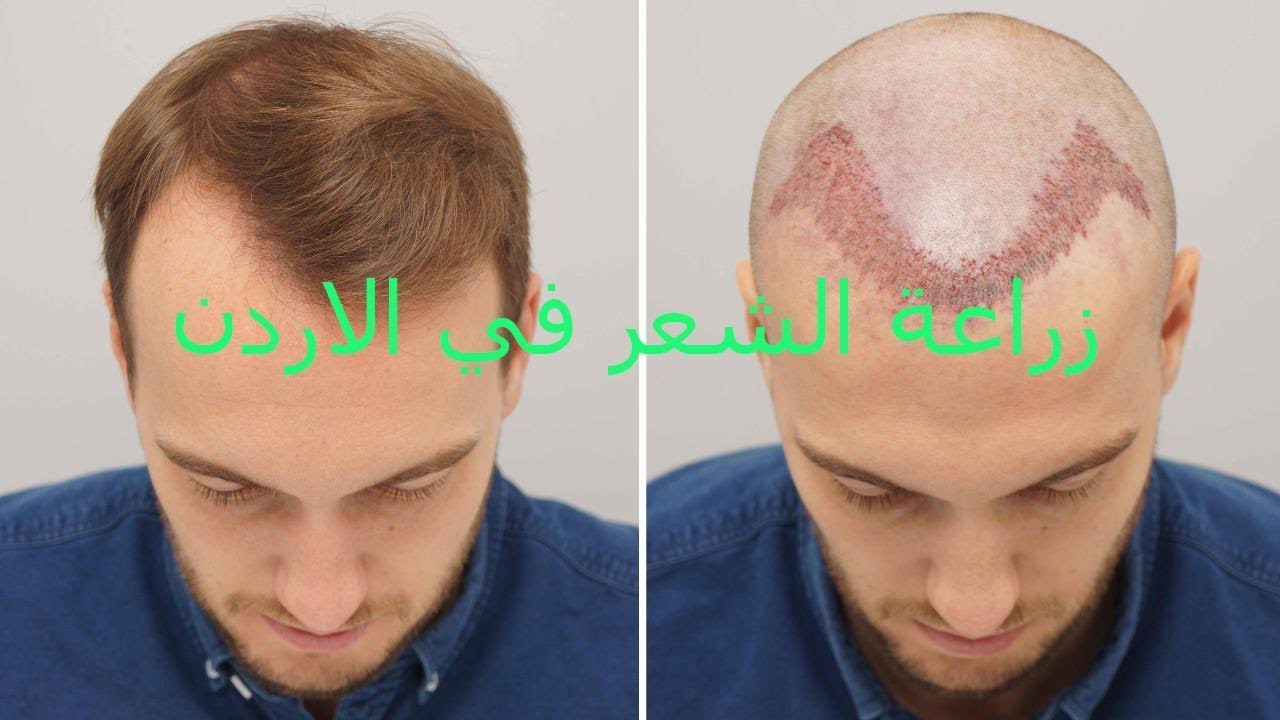 زراعة الشعر في الاردن - مميزاتها وعيوبها وتكلفتها 3587 3