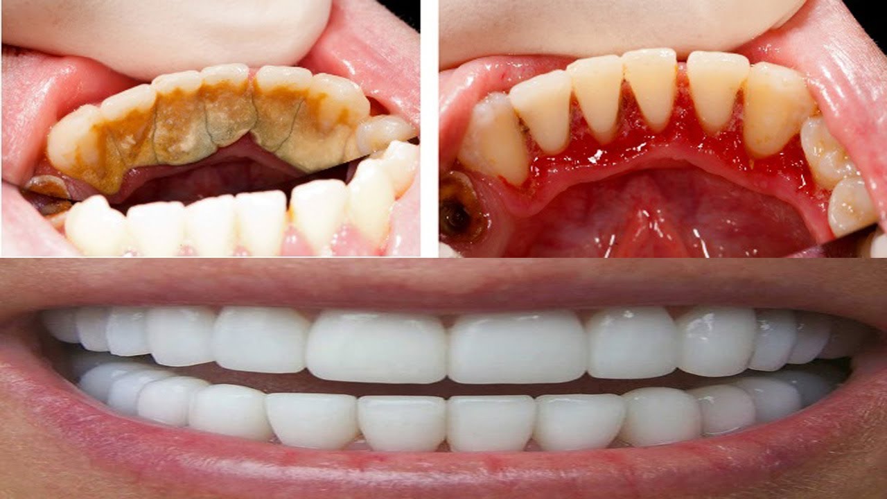 ازالة الجير من الاسنان - وصفة خطيرة وسهلة جدا 1385 1