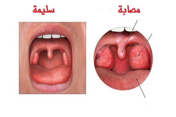 علاج التهاب اللوز للاطفال , اسرع علاجات منزليه لالتهاب اللوز للاطفال