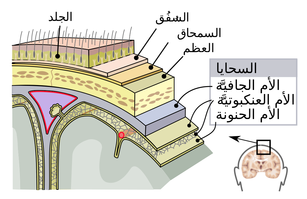 ما هو مرض الالتهاب السحائى - اخطار واعراض مرض الالتهاب السحائى المزمن 1014