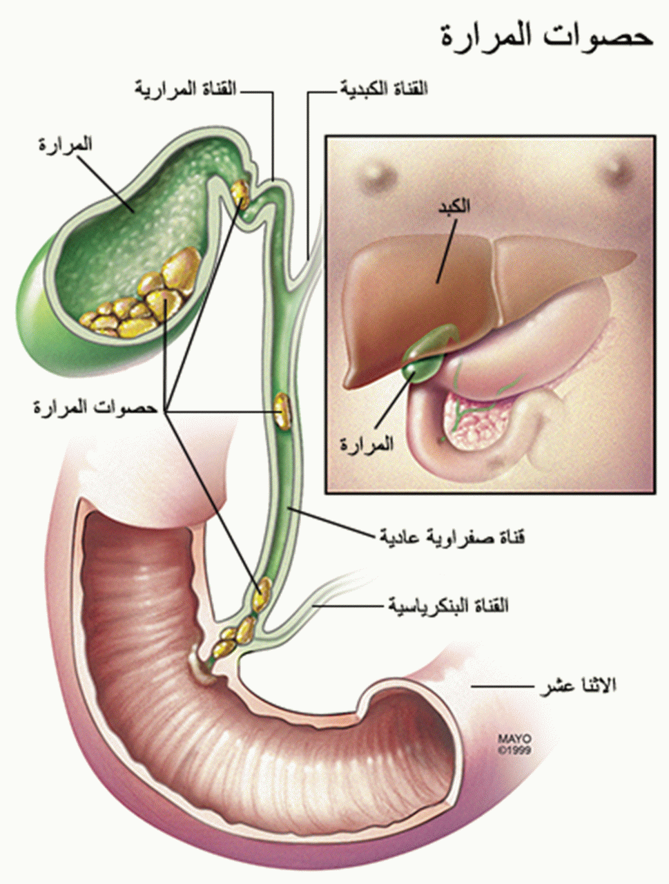 اعراض حصوة المرارة - كل ما يخص الباحث عن هذا المقال 1239