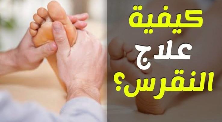 احدث علاج للنقرس - اقضي علي النقرس نهائياً