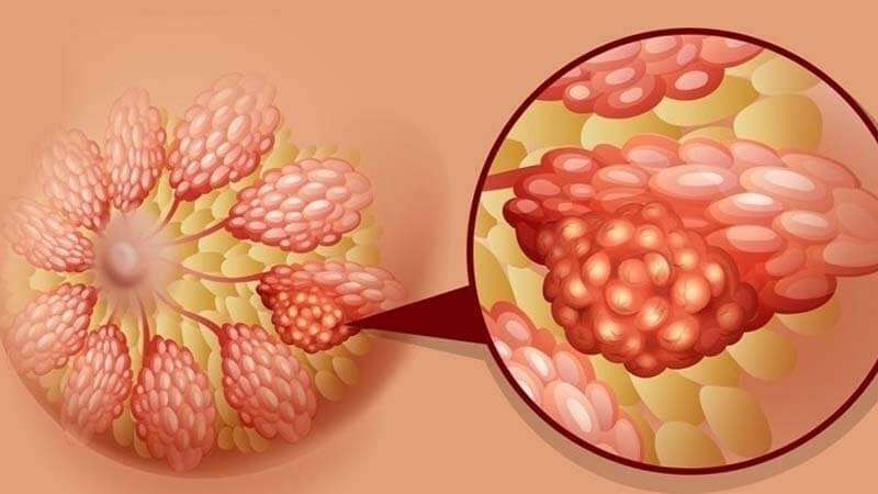 ماهي اعراض ورم الثدي , تعرفي متى يوجد ورم بالثدي