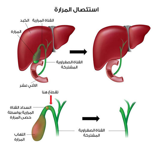 عملية جراحية للمرارة - طرق استئصال الكيس المراري 2767 11