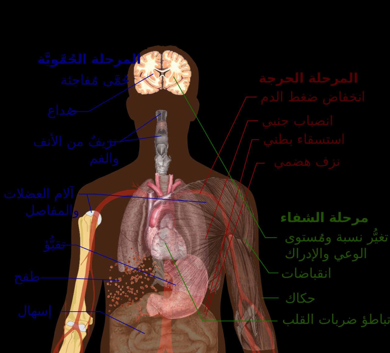 ما هي حمى الضنك , تعرف على اعراض حمى الضنك