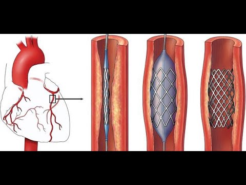 ما هي القسطرة القلبية - تعرف على قسطرة القلب و لماذا نقوم بها 4085 2