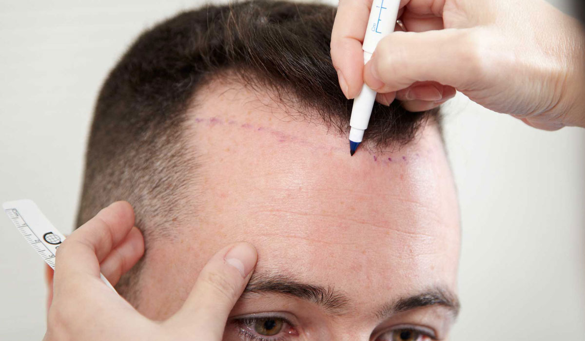 معلومات عن زراعة الشعر , طرق زراعة الشعر و مخاطرها