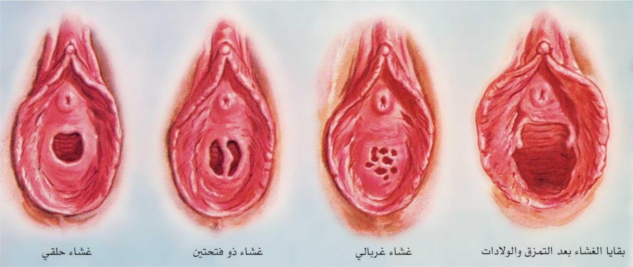 عملية غشاء بكارة , ما هي عمليه ترقيع غشاء البكاره