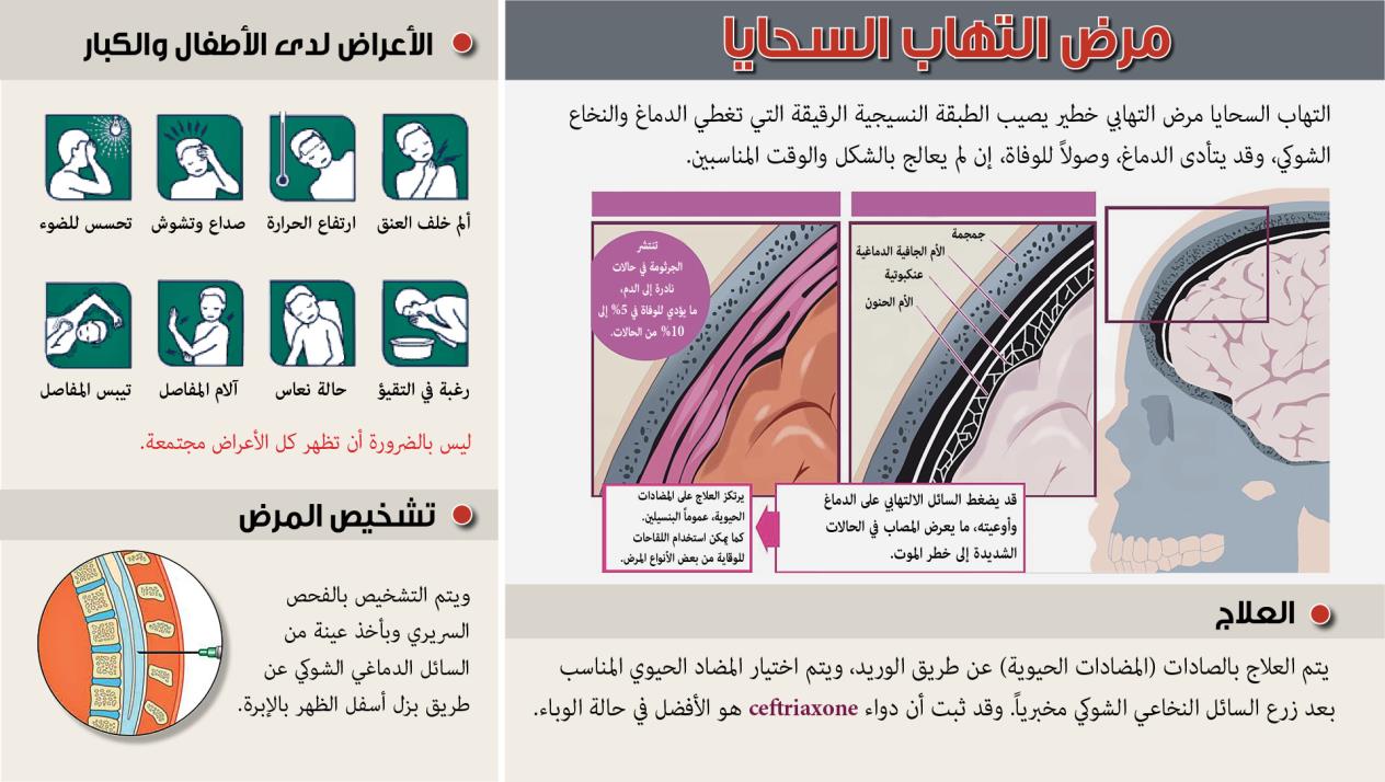 ما هو مرض الالتهاب السحائى - اخطار واعراض مرض الالتهاب السحائى المزمن 1014 2