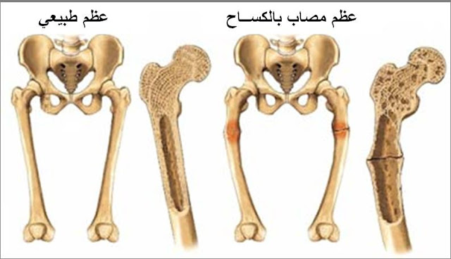 اعراض نقص فيتامين د عند الاطفال , ازاي تعرفي ان طفلك عنده نقص فيتامين د