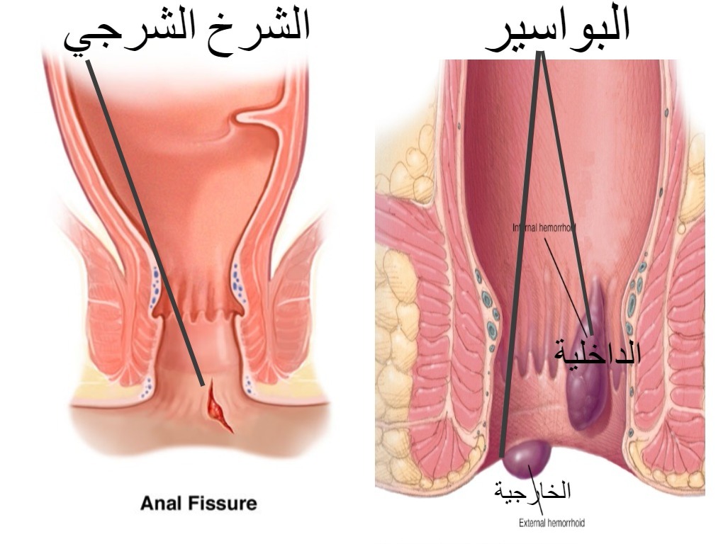 ماهي اسباب البواسير , العوامل التي تؤدي الى الاصابه بالبواسير