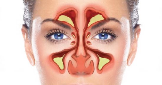 هل تعاني من الزكام من الممكن ان يكون الجيوب الانفيه تعرف علي اعراضها - اعراض الجيوب الانفية 499 1