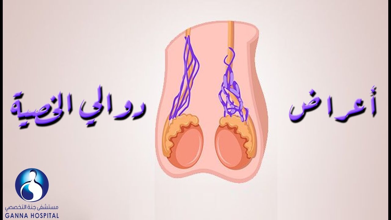 ما هو دوالي الخصية , علاج الدوالى بسهوله