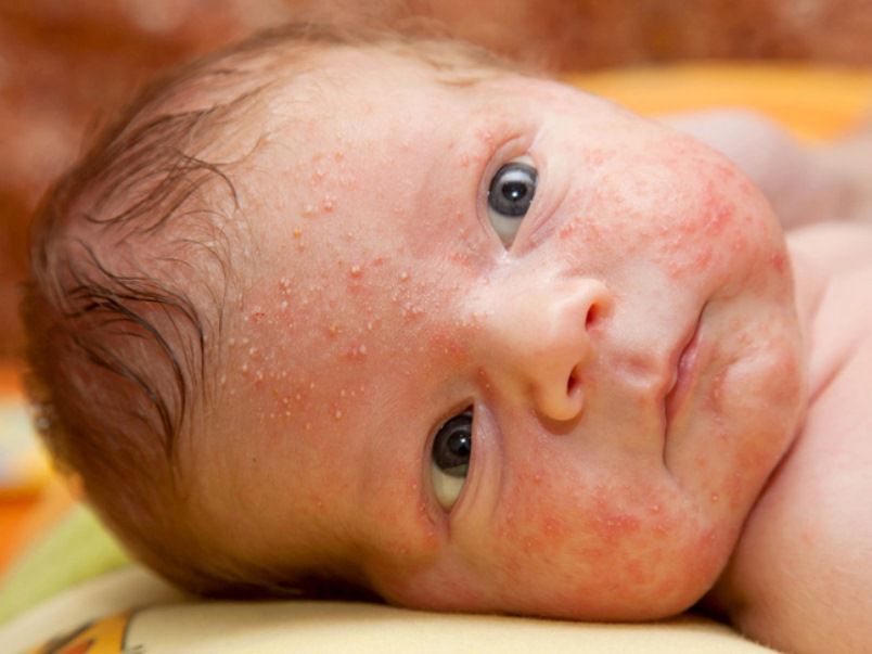 حساسية الجلد عند الرضع , الحساسيه عند الاطفال الرضع - طقطقه