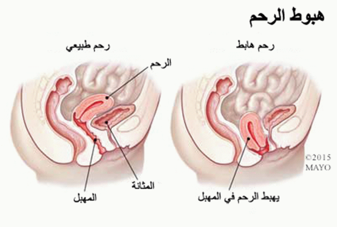 متي تعرفين ان رحمك تم سقوطه , علاج سقوط الرحم